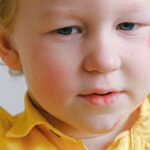 child-burned-face