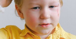 Illustration de Balle antistress explosive : un enfant défiguré, la DGCCRF impuissante child-burned-face